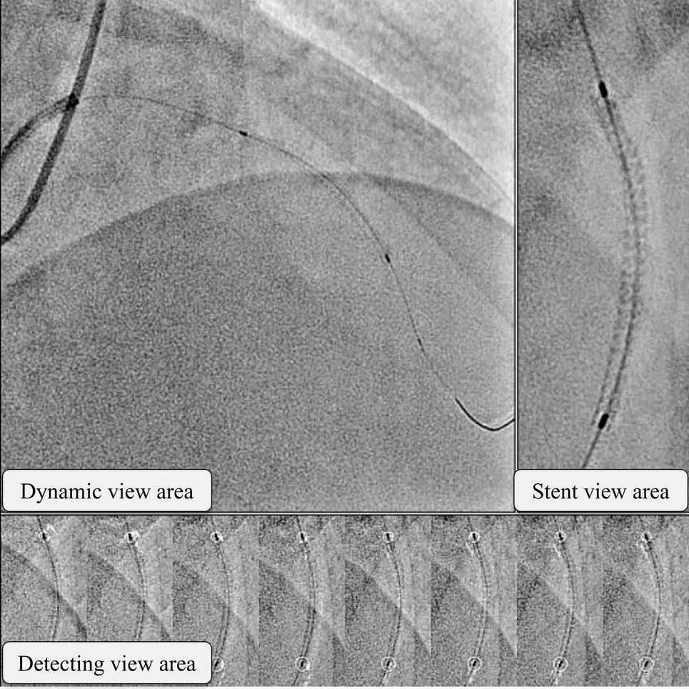 Investigation of patient radiation exposure reduction through optimization of imaging conditions for stent enhancement processing in percutaneous coronary intervention: a retrospective study