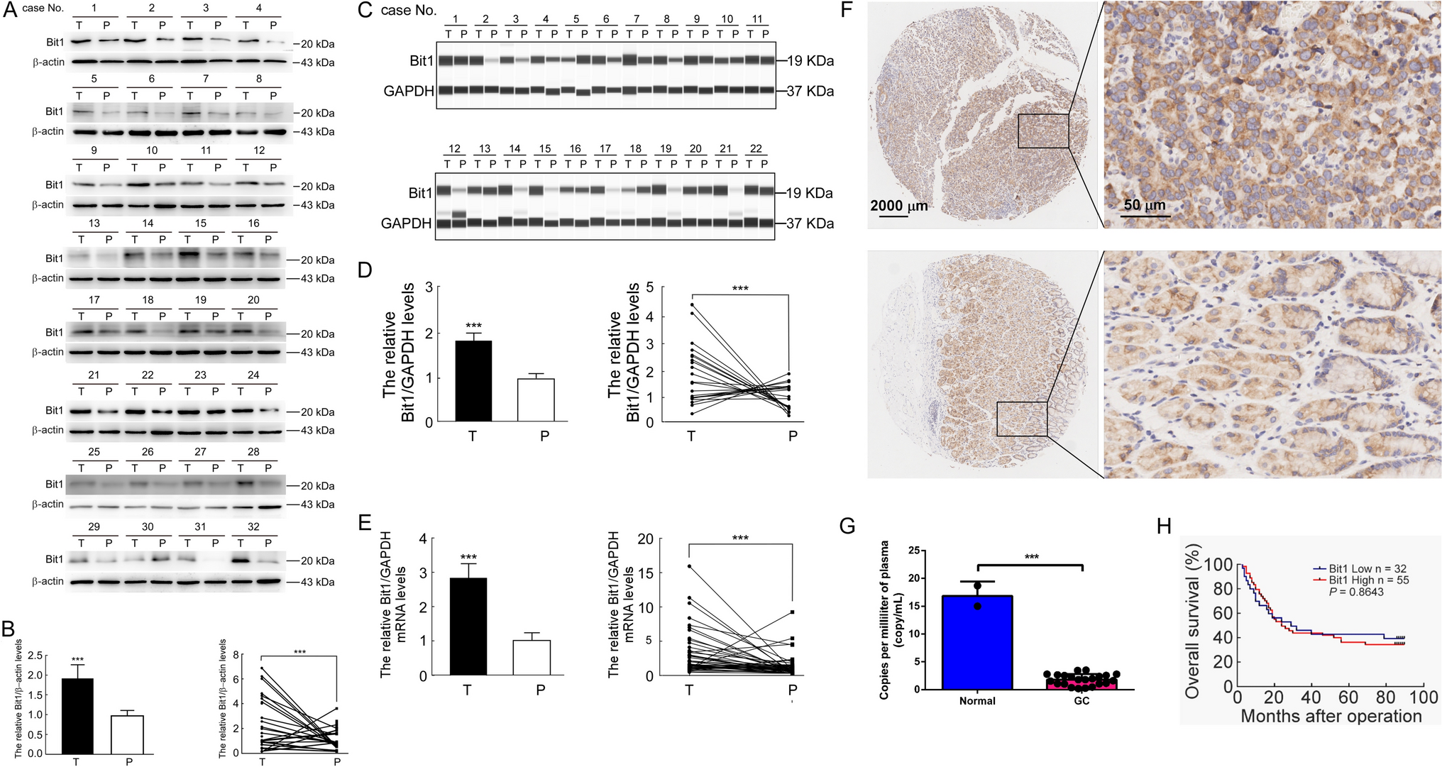 Bit1 promotes the progression of gastric cancer by facilitating epithelial–mesenchymal transition and alleviating apoptosis