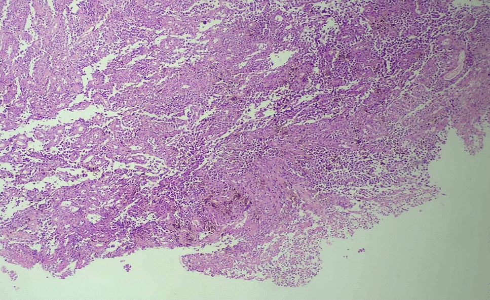 A rare case of primary prostate melanoma with extensive secondaries: case report