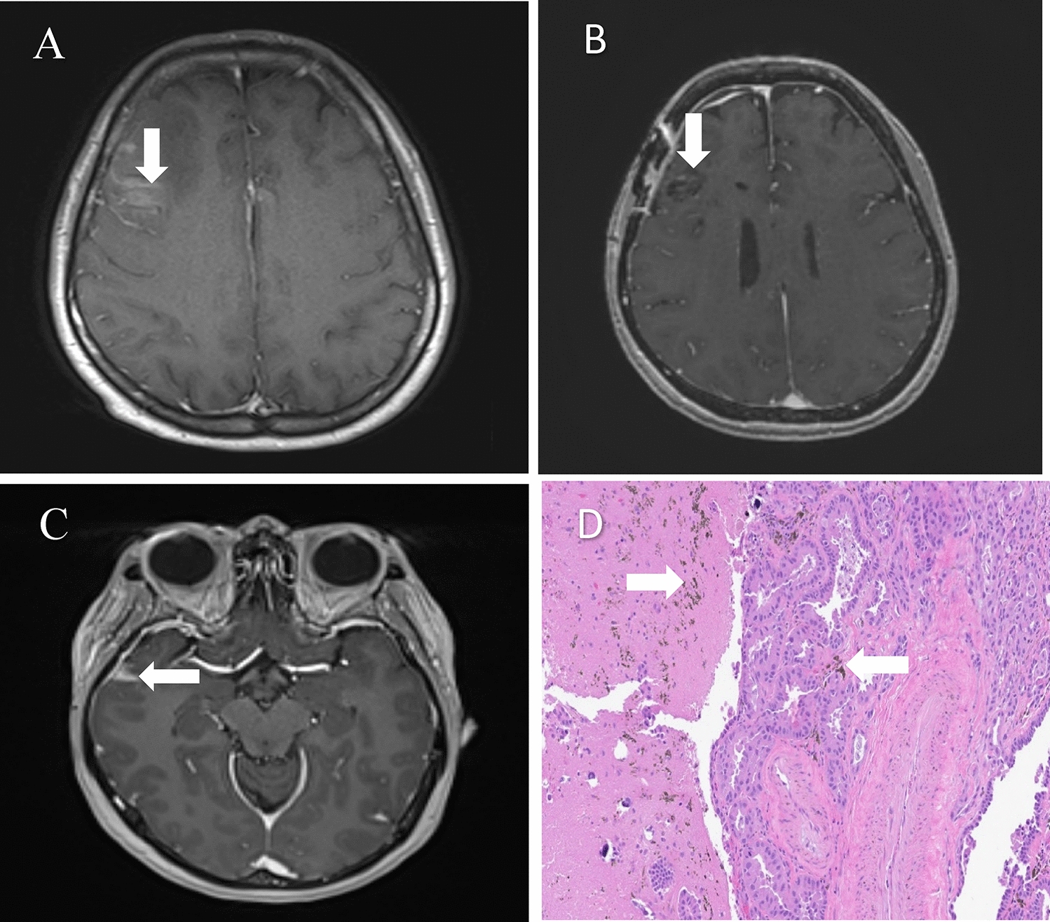 Extended survival in a patient with leptomeningeal disease related to EGFR exon 19 deletion metastatic non-small cell lung cancer: a case report