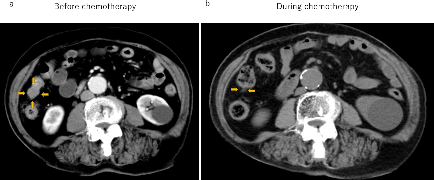 Low-dose oral cyclophosphamide with or without bevacizumab treatment in patients with recurrent ovarian and cervical cancer before best supportive care