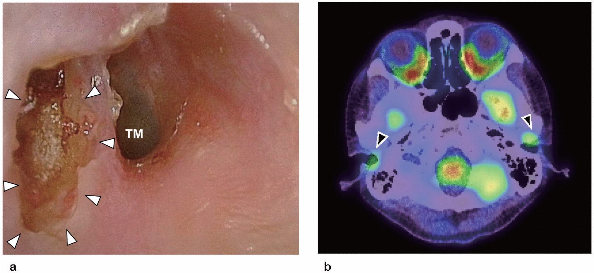 Bilateral osteonecrosis of the external auditory canal caused by bone-modifying agents for cancer bone metastases