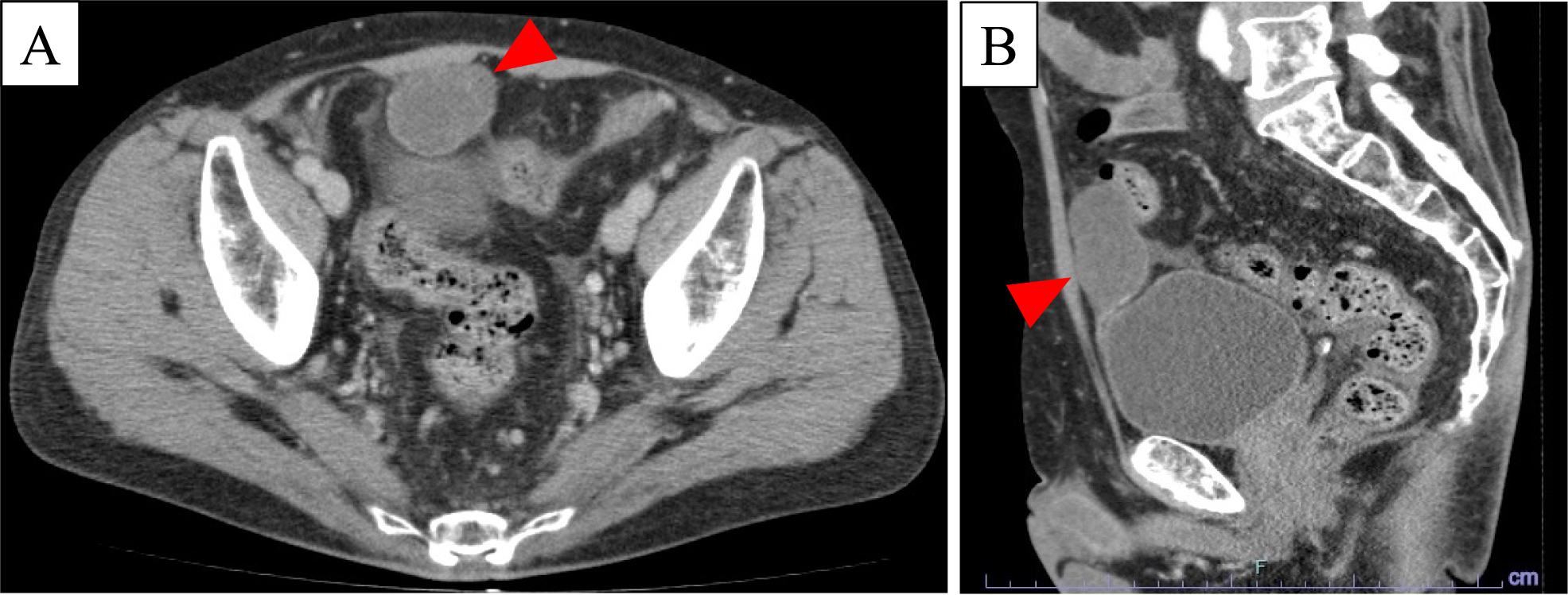 Metastatic urachal carcinoma treated with trifluridine/tipiracil and bevacizumab: a case report