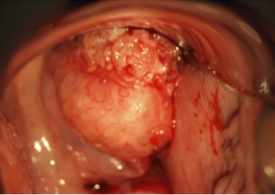Primary carcinosarcoma of the uterine cervix with somatic mutations of the  and  genes: a case report