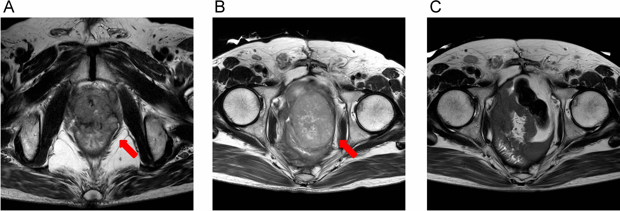 Complete response to pembrolizumab in mismatch repair-deficient urothelial carcinoma with local recurrence and recurrent upper tract urothelial carcinoma: a case report