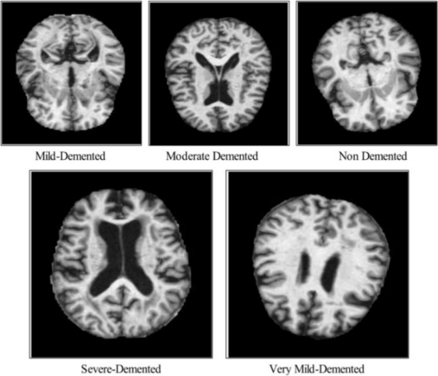 CBAM-XAI: Convolutional Block Attention Module Enhanced Explainable Artificial Intelligence-Based Parkinson’s Disease Stage Classification