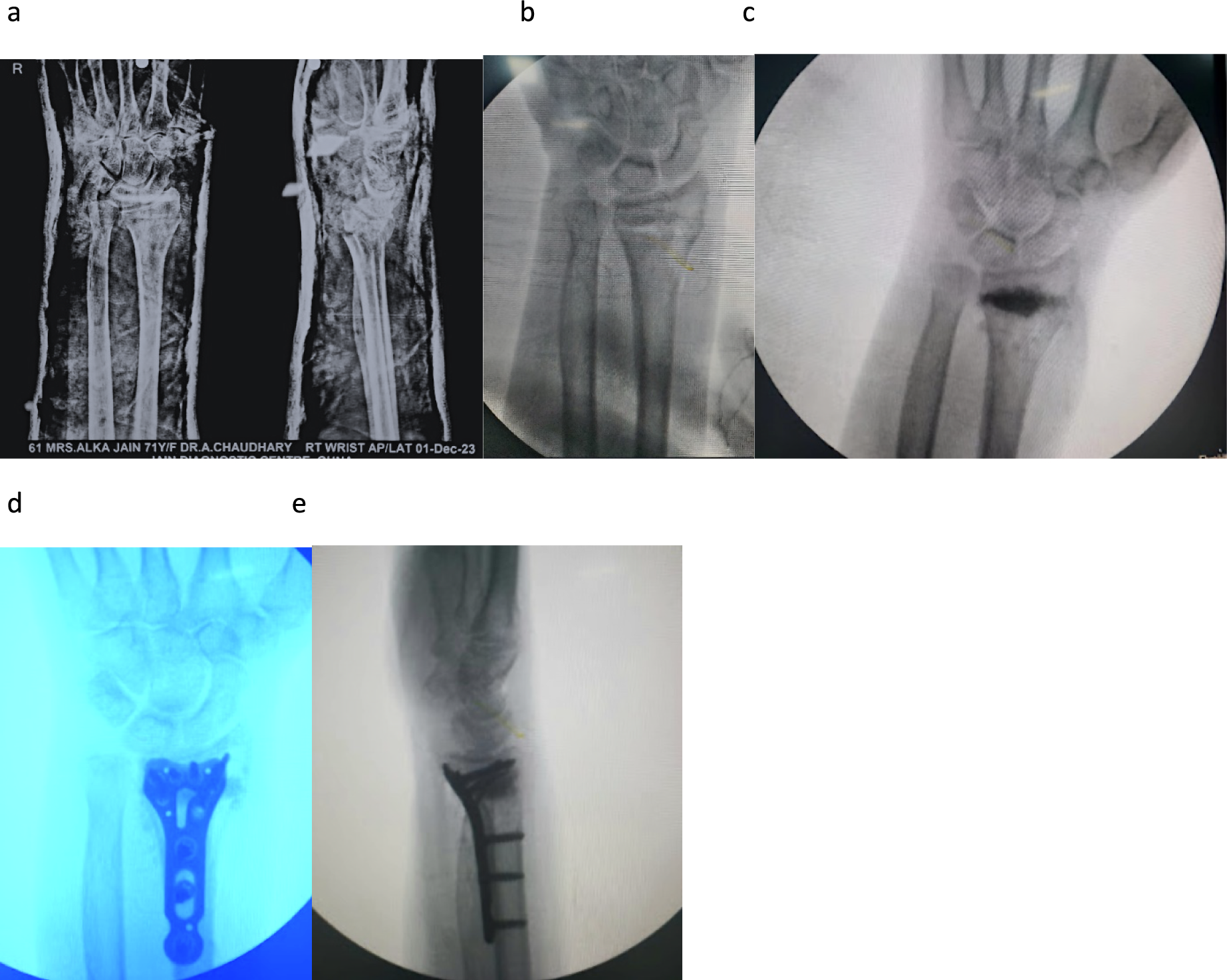 Osteoporotic Distal Radius Fracture: Surgical Care