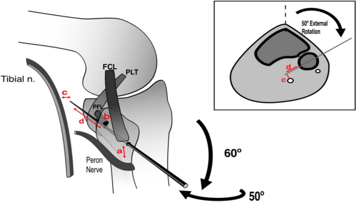 Precision Matters: Comparative Analysis of Fibular Tunnel Trajectories in PLC Reconstruction: A Cadaveric Study