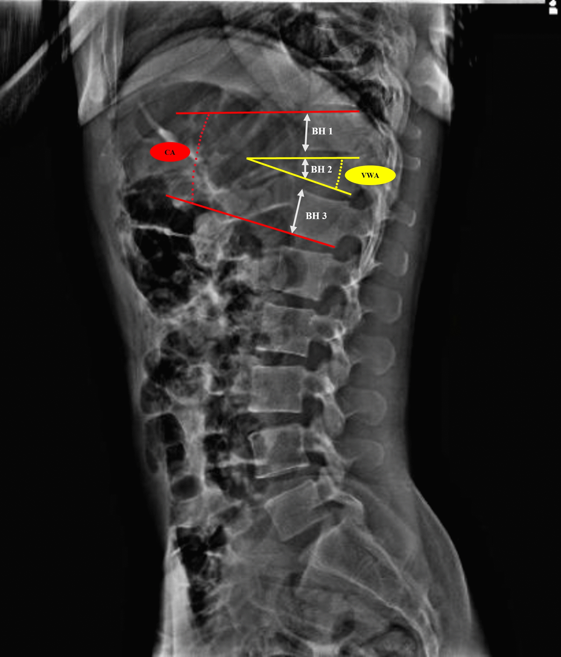 Single vs Double Index Screws in Thoracolumbar Burst Fractures: A Retrospective Analysis