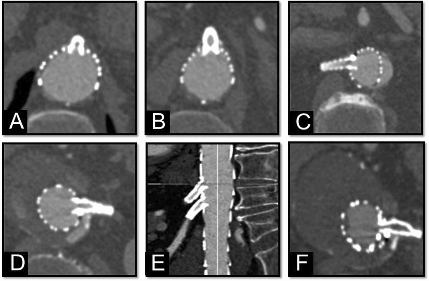 Feasibility of Inner Side Branches with Large Diamond-Shaped Outlet for Redo Fenestrated/Branched Aortic Repair (F/BEVAR) After Failed FEVAR