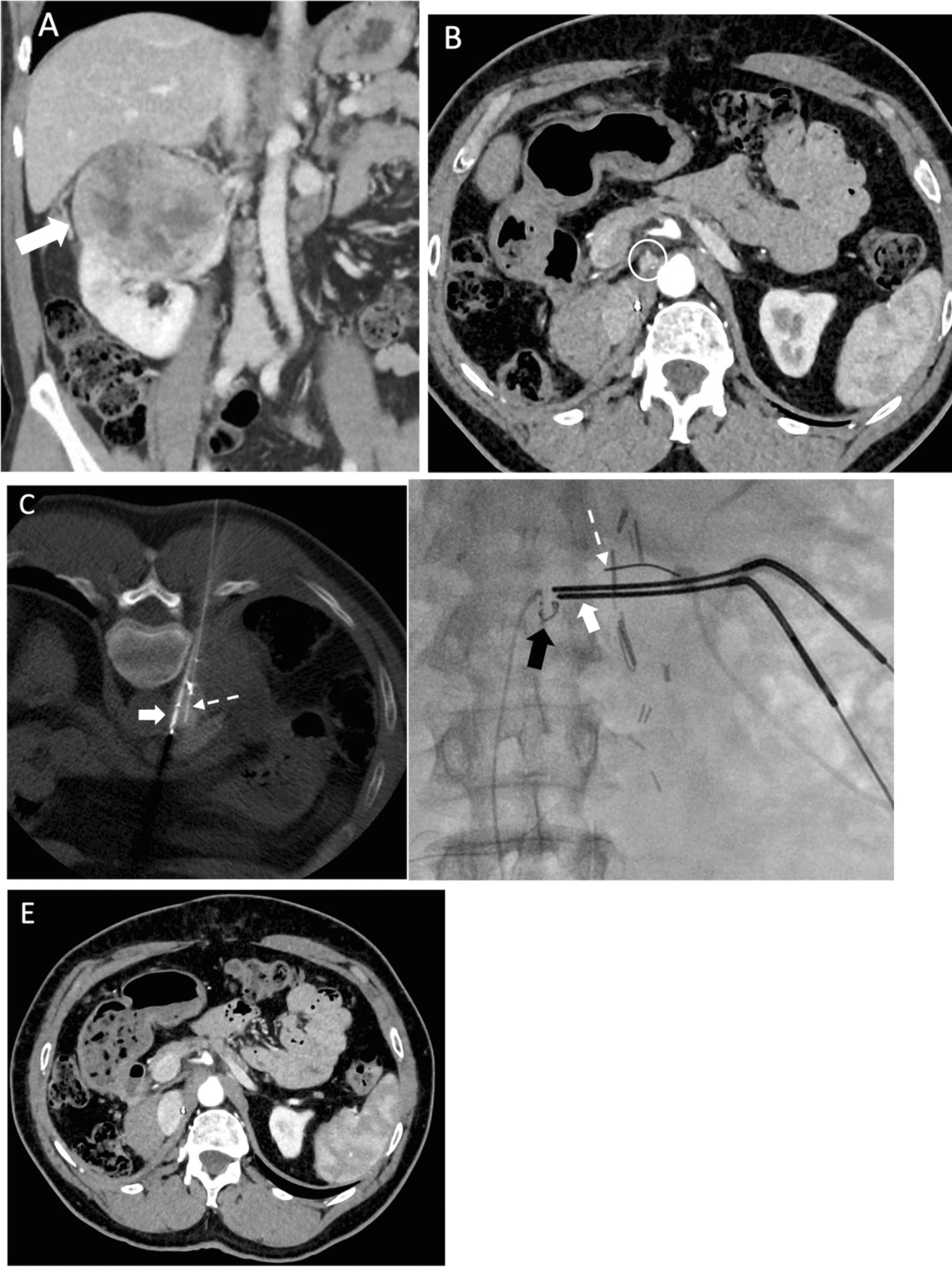 Beyond the Scalpel: the Role of Image-Guided Thermal Ablation in Management of Metastatic Renal Cell Carcinoma in the Era of Immunotherapy