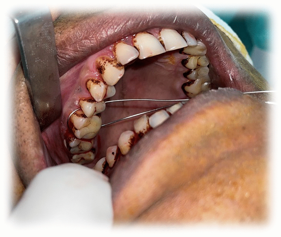 Palato-lingual Direct-cross Wire Maxillo-mandibular Fixation: A Modified Technique for management of Mandibular Fractures and a Comparative Study