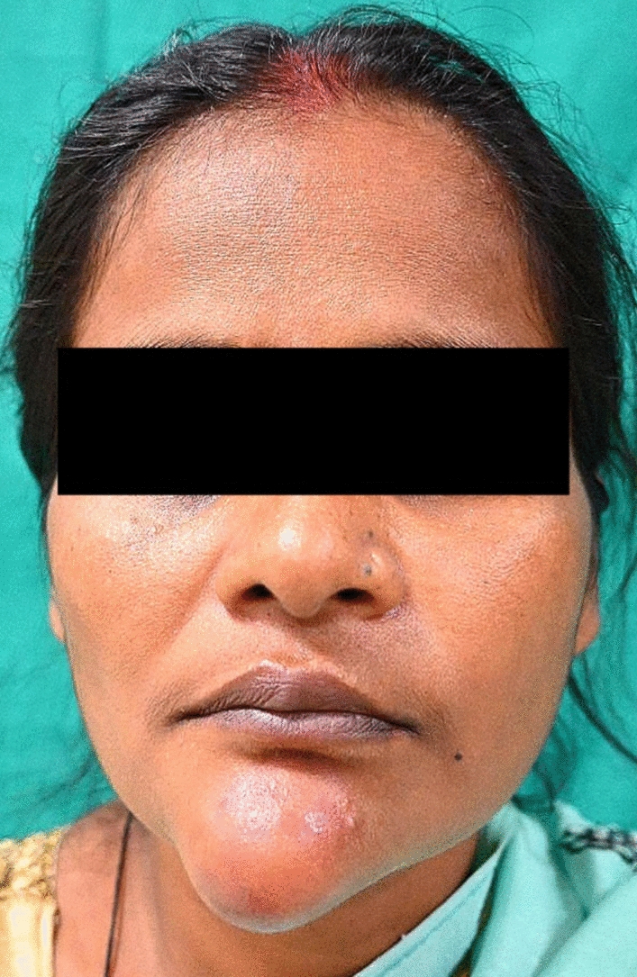 Synovial Sarcoma of Symphysis of Mandible