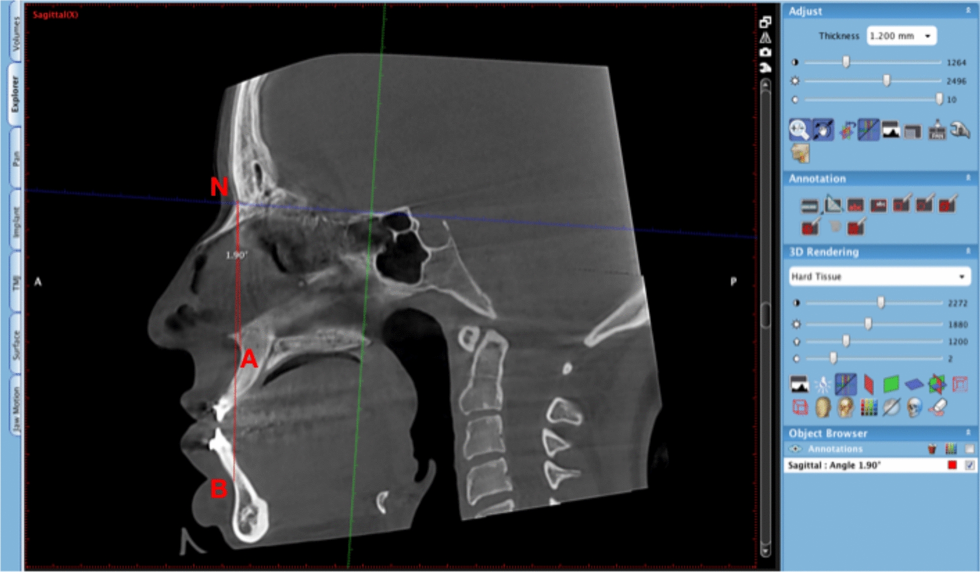 Cone-Beam Computed Tomography (CBCT) Assessment of the Inter-Radicular Bone Thickness in the Anterior Maxilla in an Iranian Population