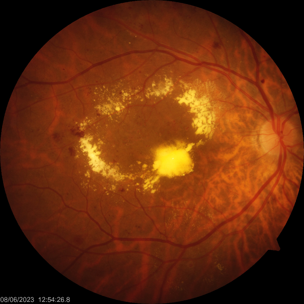 Preventive and therapeutic strategies via health care delivery system to minimize sight-threatening diabetic retinopathy: a narrative review