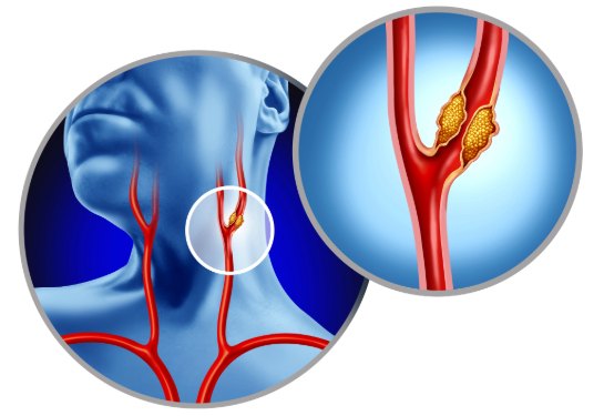 UC Davis Health enrolls first patient in carotid artery stent trial