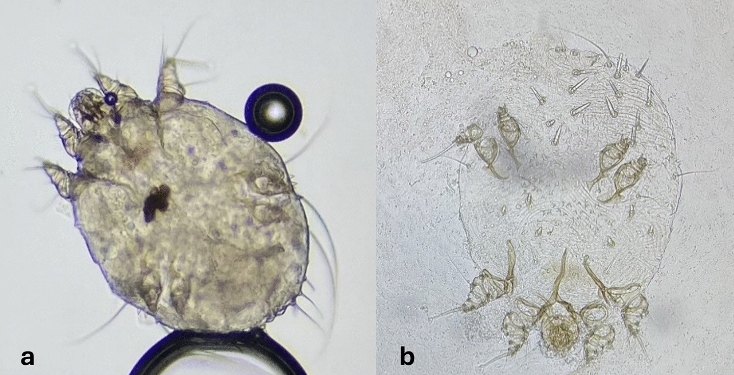 Scabies in older adults: What Is New in Diagnosis and Treatment?