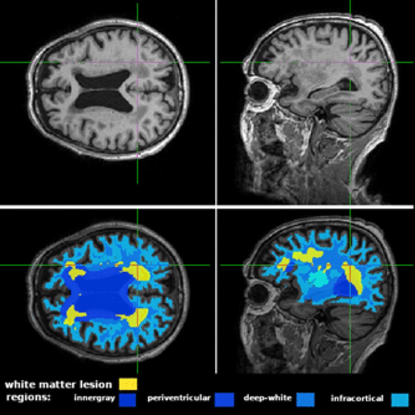 From the plate to the brain: associations between dietary patterns and reduced dementia prevalence and white matter lesions in older Japanese adults