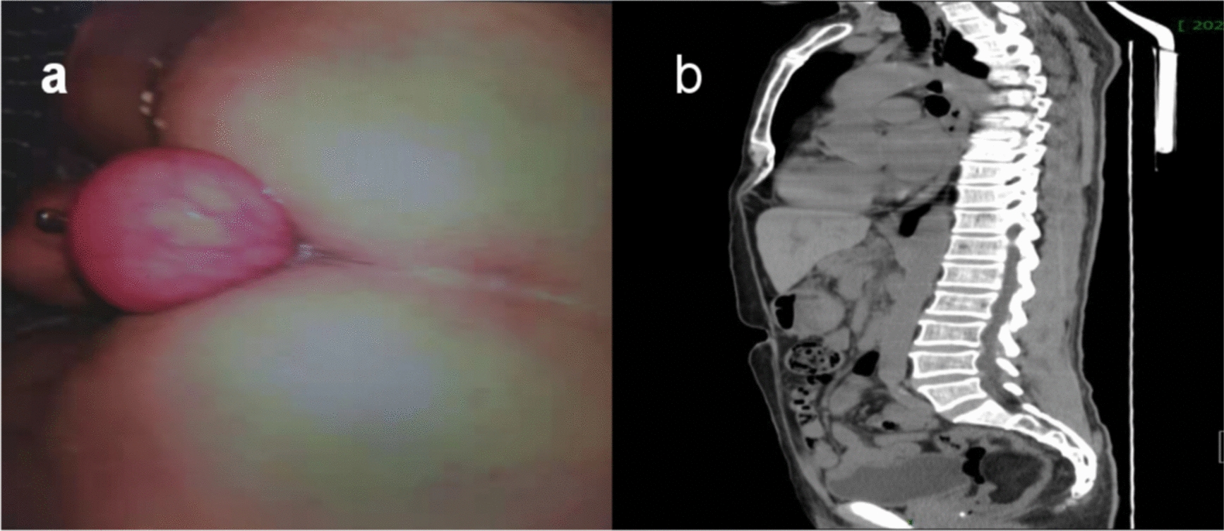 Endoscopic Ultrasound-Assisted Submucosal Dissection of a Giant Rectal Lipoma Presenting as Partial Prolapse