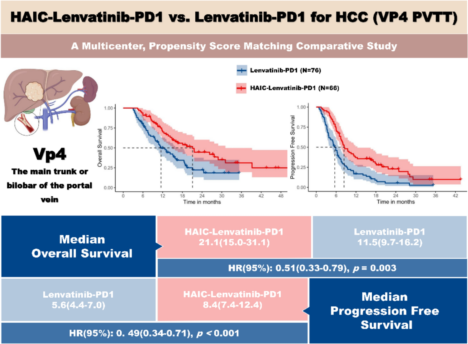 Hepatic arterial infusion chemotherapy combined with lenvatinib and programmed death receptor-1 inhibitors for hepatocellular carcinoma with Vp4 portal vein tumor thrombus: a multicenter, propensity score matching comparative study