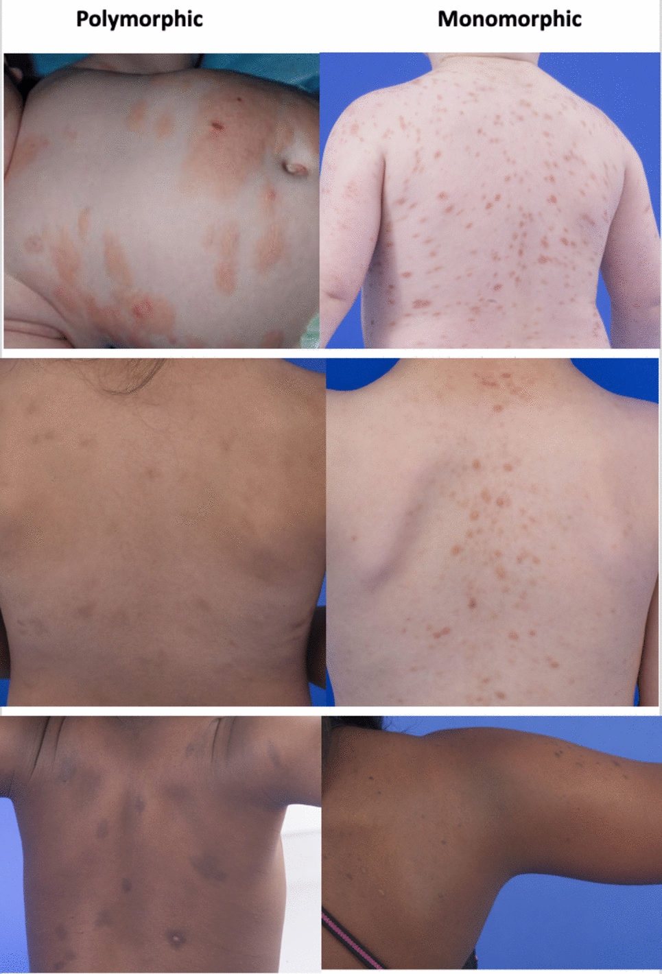 Mastocytosis in the Skin: Approach to Diagnosis, Evaluation, and Management in Adult and Pediatric Patients