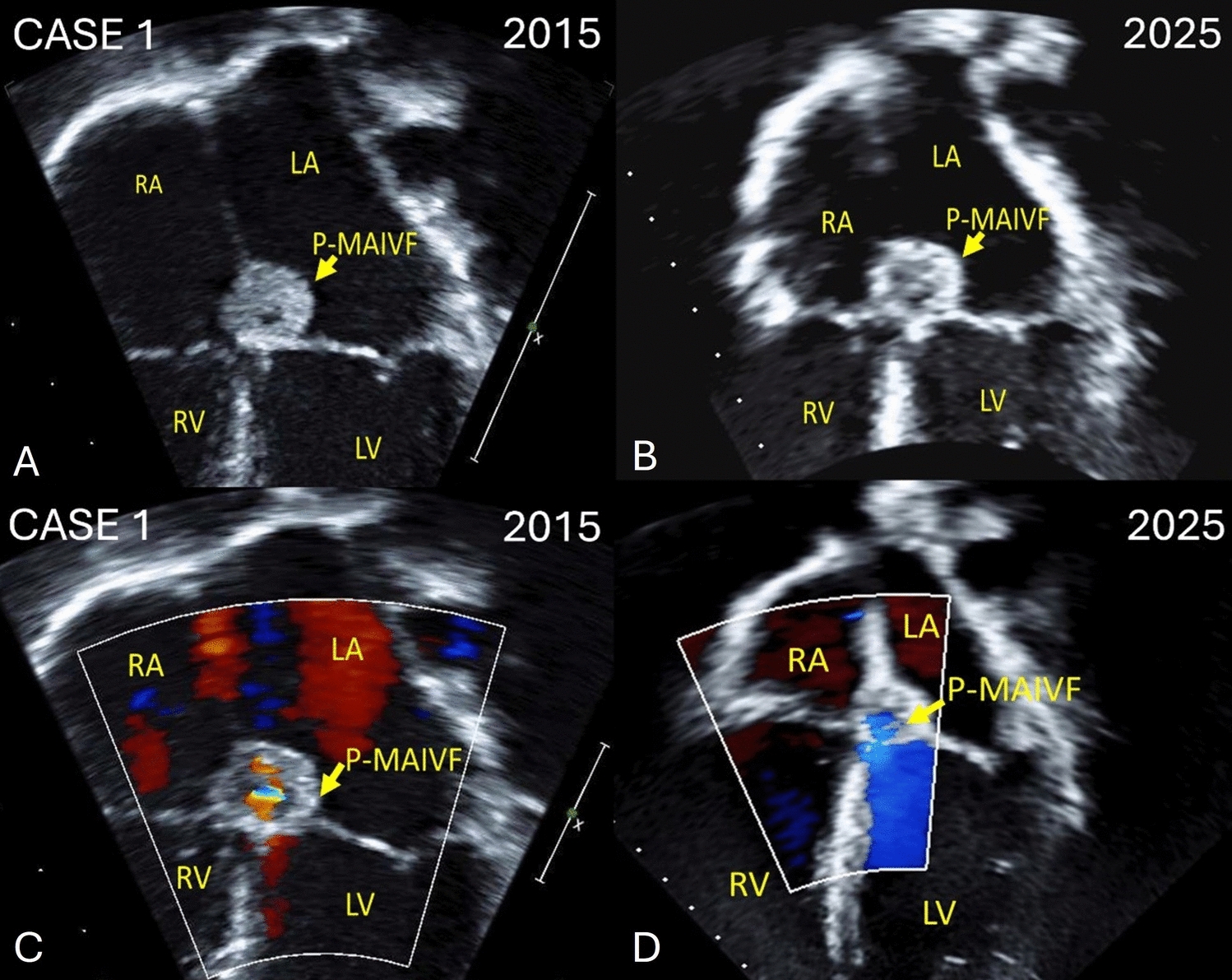 Congenital pseudoaneurysm of mitral-aortic intervalvular fibrosa in healthy children