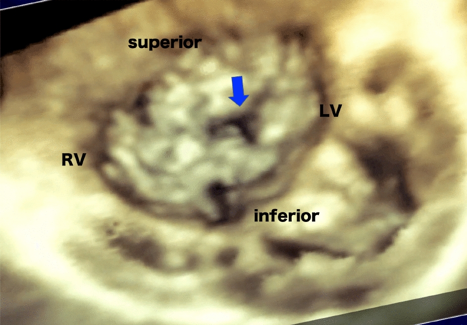 The impact of intraoperative pericardial three-dimensional echocardiography for the atrioventricular valve repair in pediatric patients of congenital heart disease