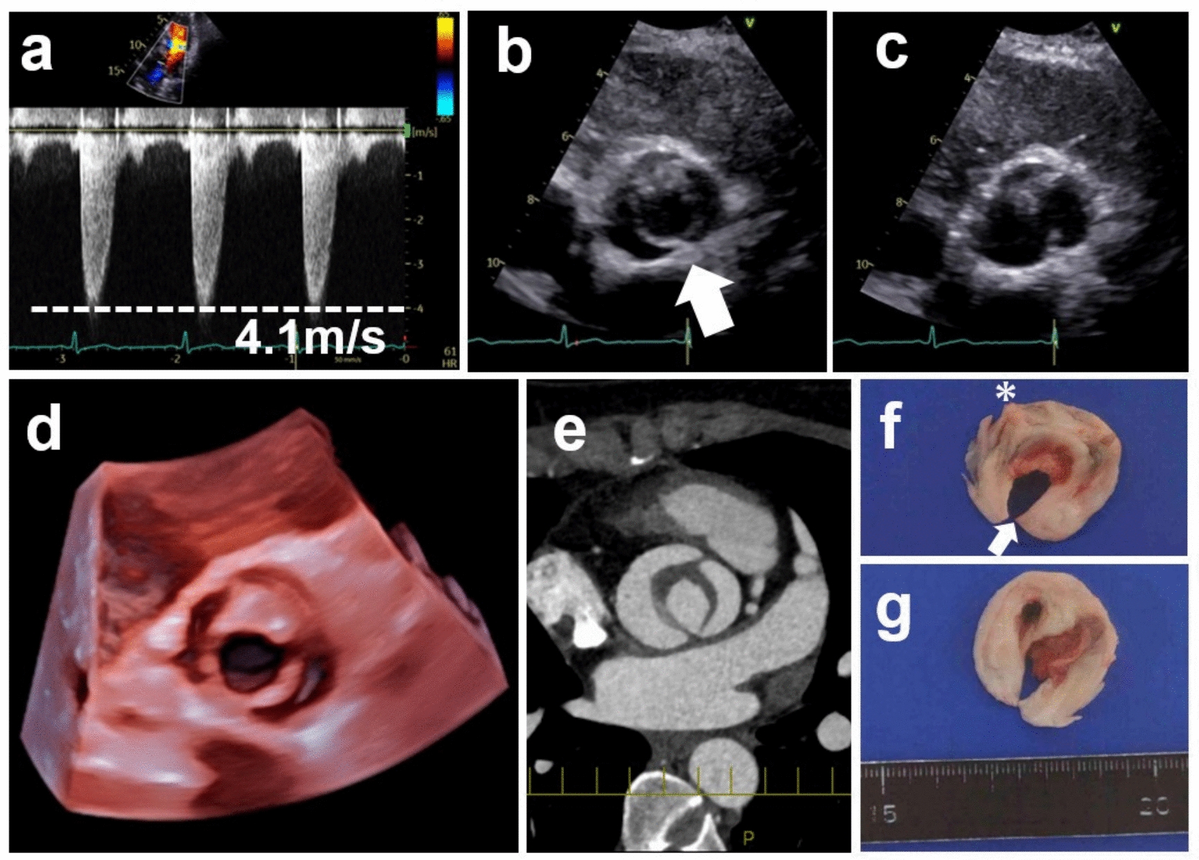 Unicuspid aortic valve diagnosed by transthoracic 3-dimensional echocardiography with rapidly progressing aortic stenosis