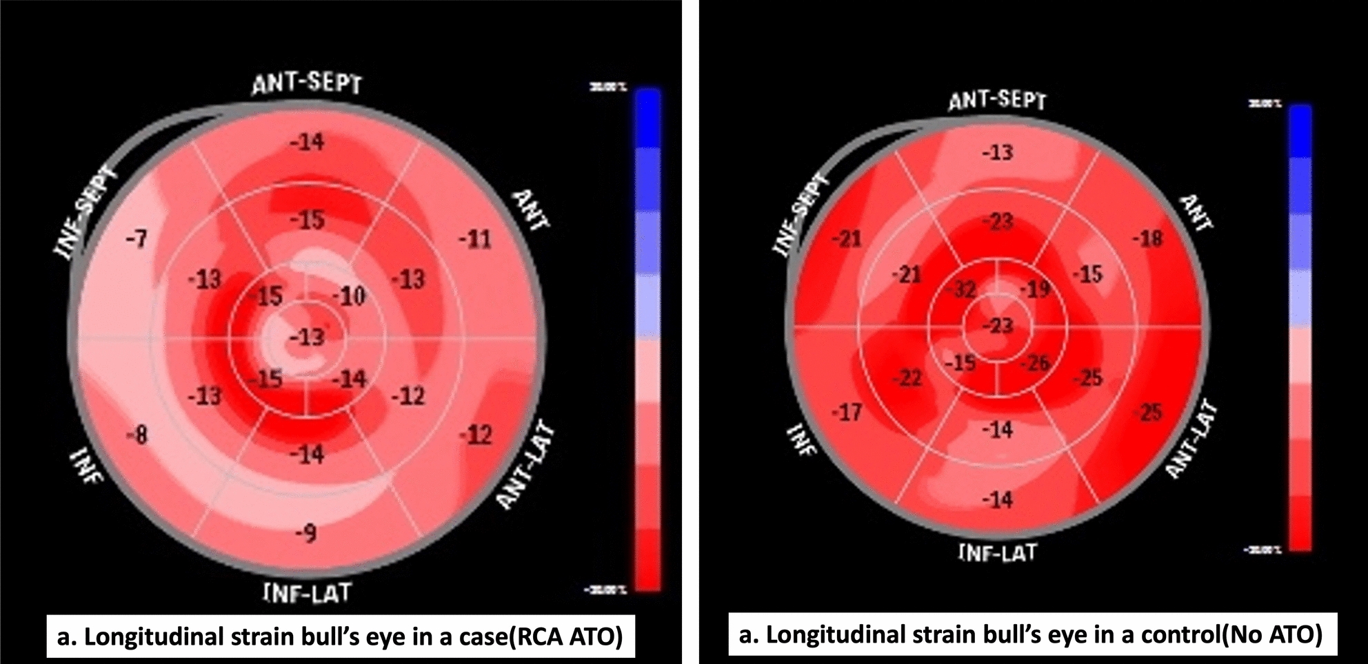 Echocardiographic speckle tracking as a tool for detecting acute total occlusion in non-ST-elevation myocardial infarction: a case–control study