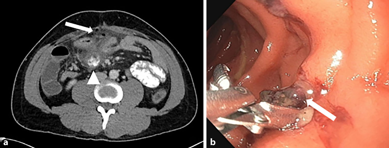 Clip migration into the duodenum after laparoscopic oncological hemicolectomy—a case report