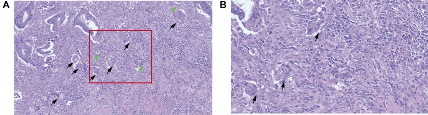 The value and application of a poorly differentiated cluster-based Ezrin marginal score system in the prognostic assessment of colorectal cancer