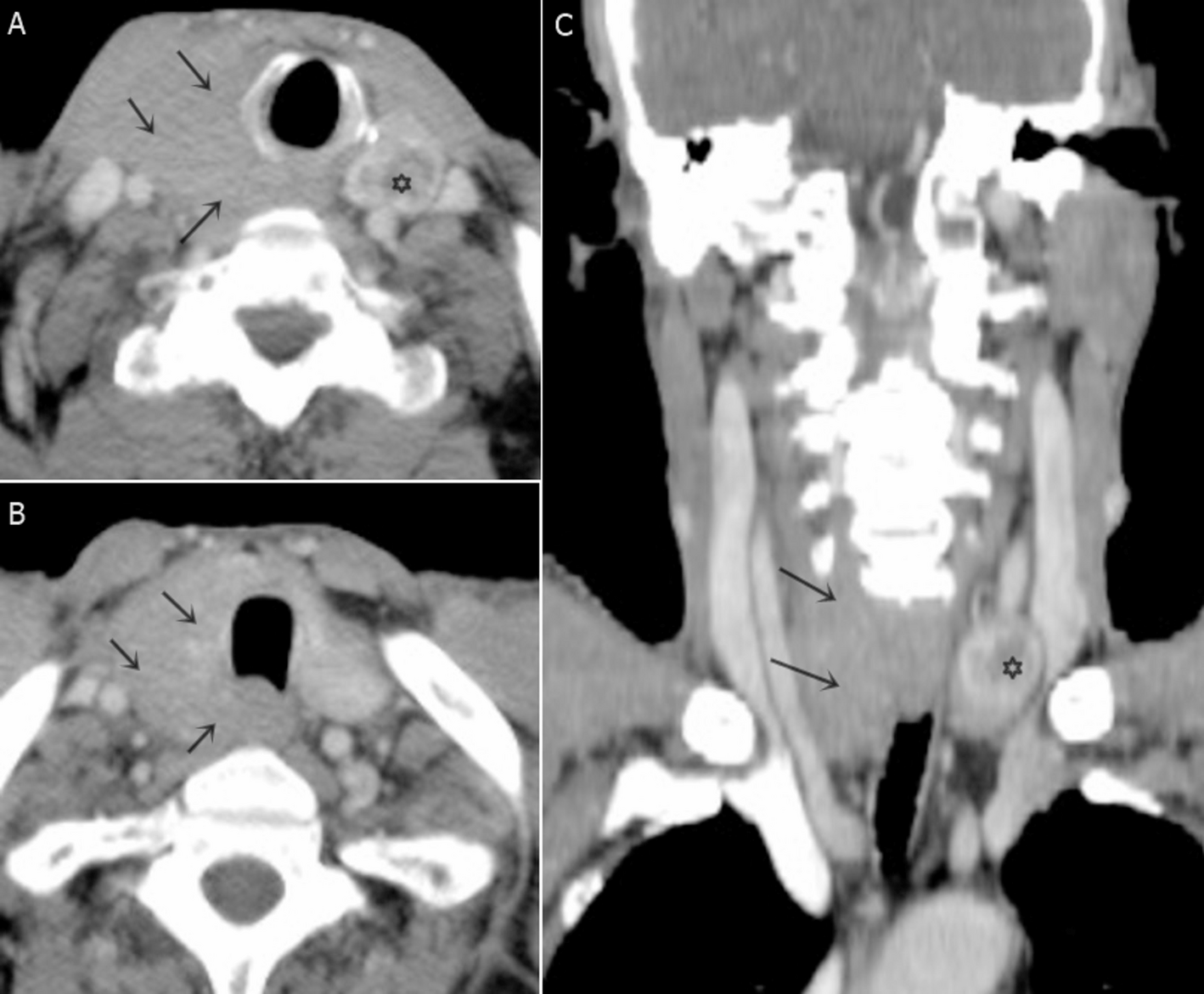 Diagnosis and treatment outcomes of primary lymphoma of the thyroid gland