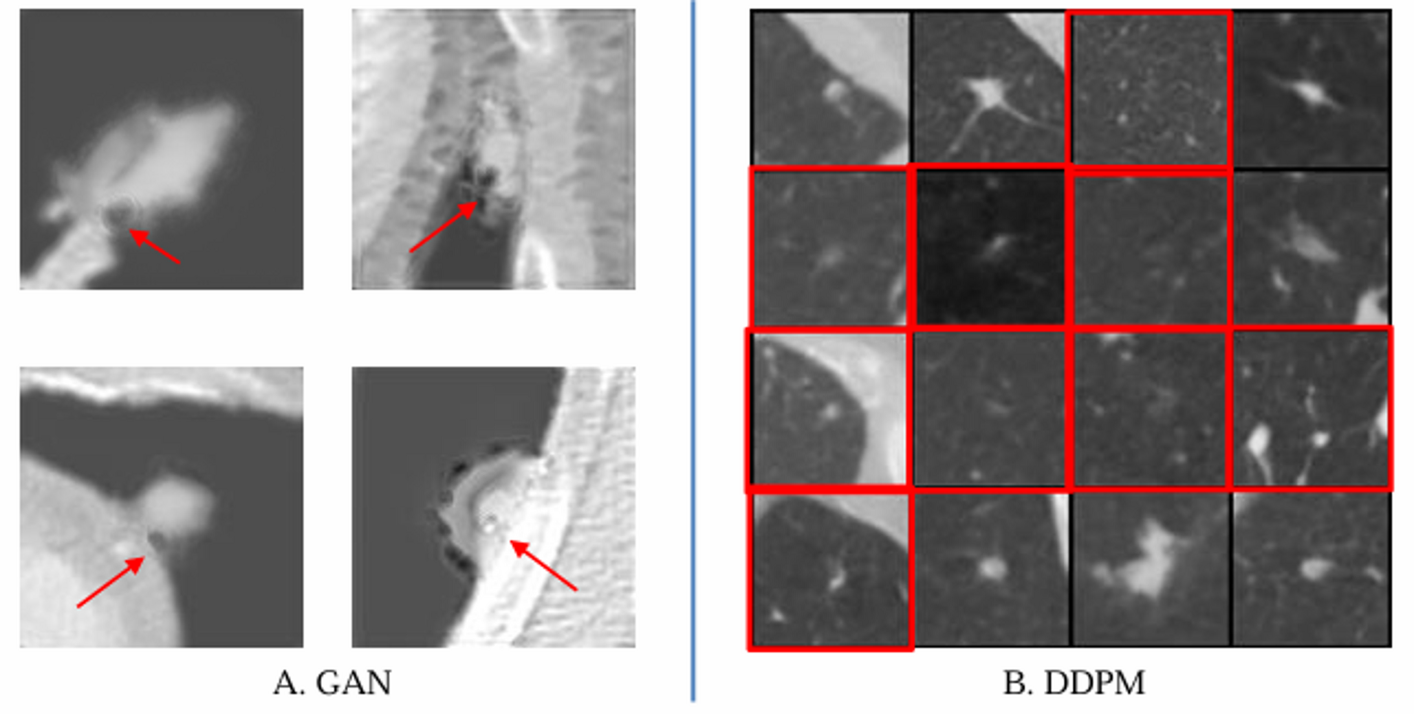 Lung nodule synthesis guided by customized multi-confidence masks