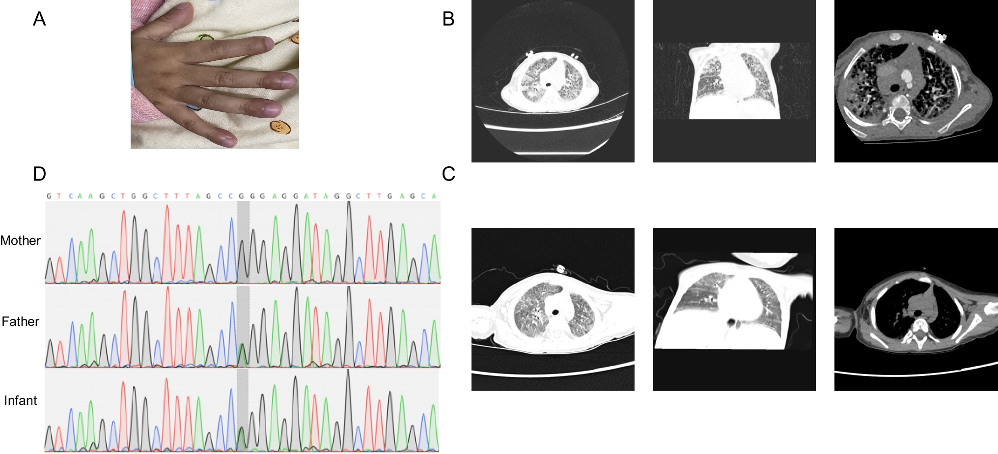 Severe interstitial lung disease as the first manifestation of a  variant in a familial case