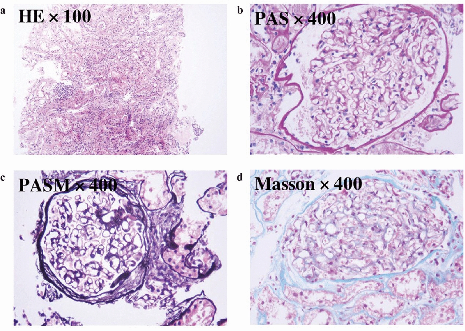 Case report: a novel heterozygous COL4A4 mutation causing autosomal dominant Alport syndrome