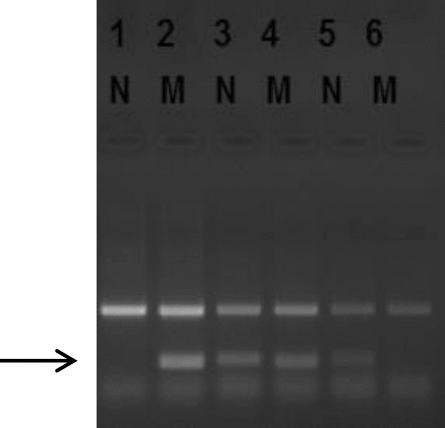 β-thalassemia due to de novo mutation IVS1-5(G > C) at HBB gene in three cases from West Bengal