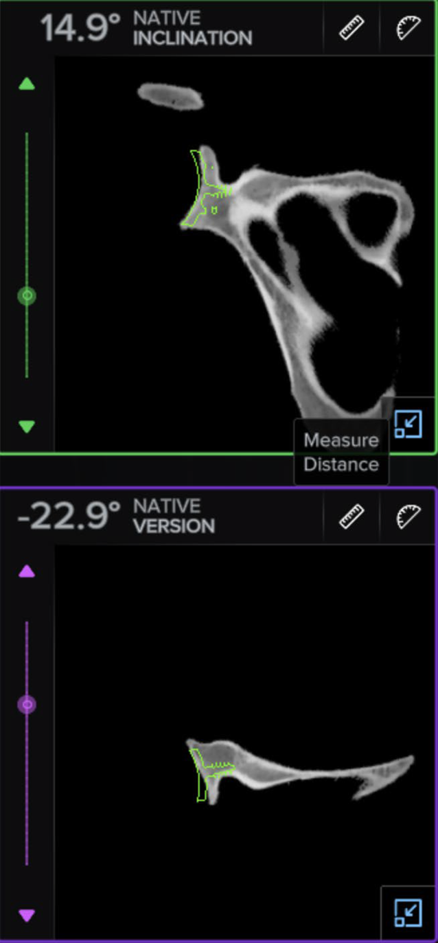 Intraoperative Navigation in der anatomischen Schulterendoprothetik