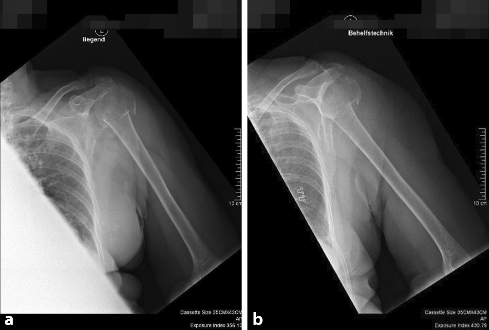 Hematogenous infection in a proximally fractured humerus managed nonoperatively: a case report