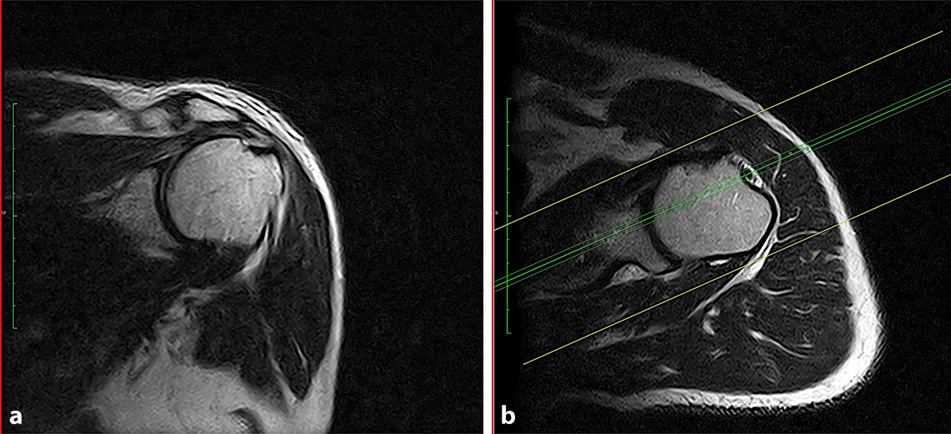 Magnetresonanztomographie am Schultergelenk