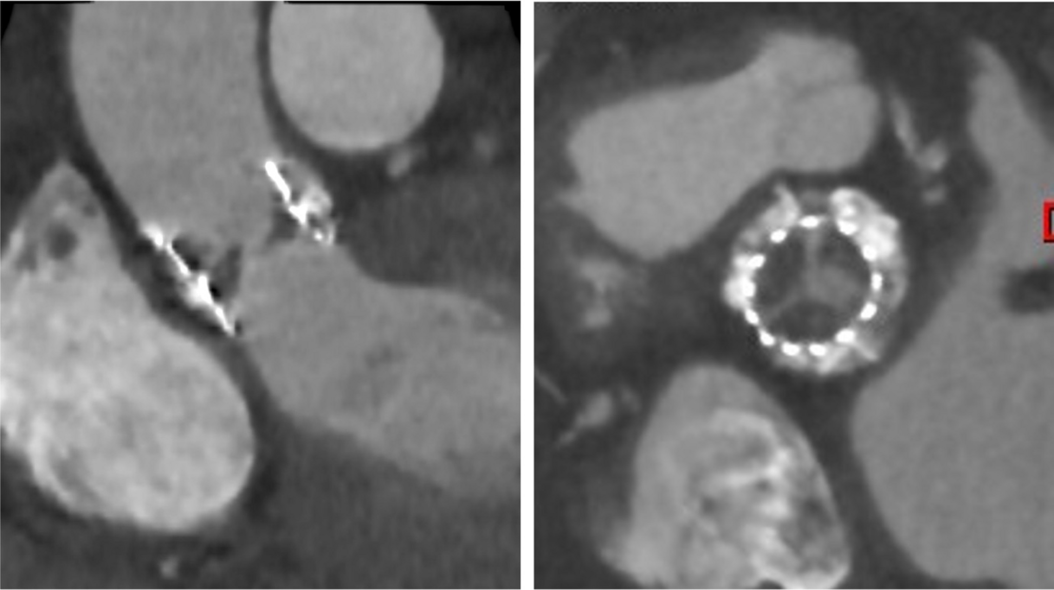 Hypoattenuated Leaflet Thickening Following Transcatheter Aortic Valve Replacement: Pathophysiology, Diagnosis, and Evolving Management Strategies