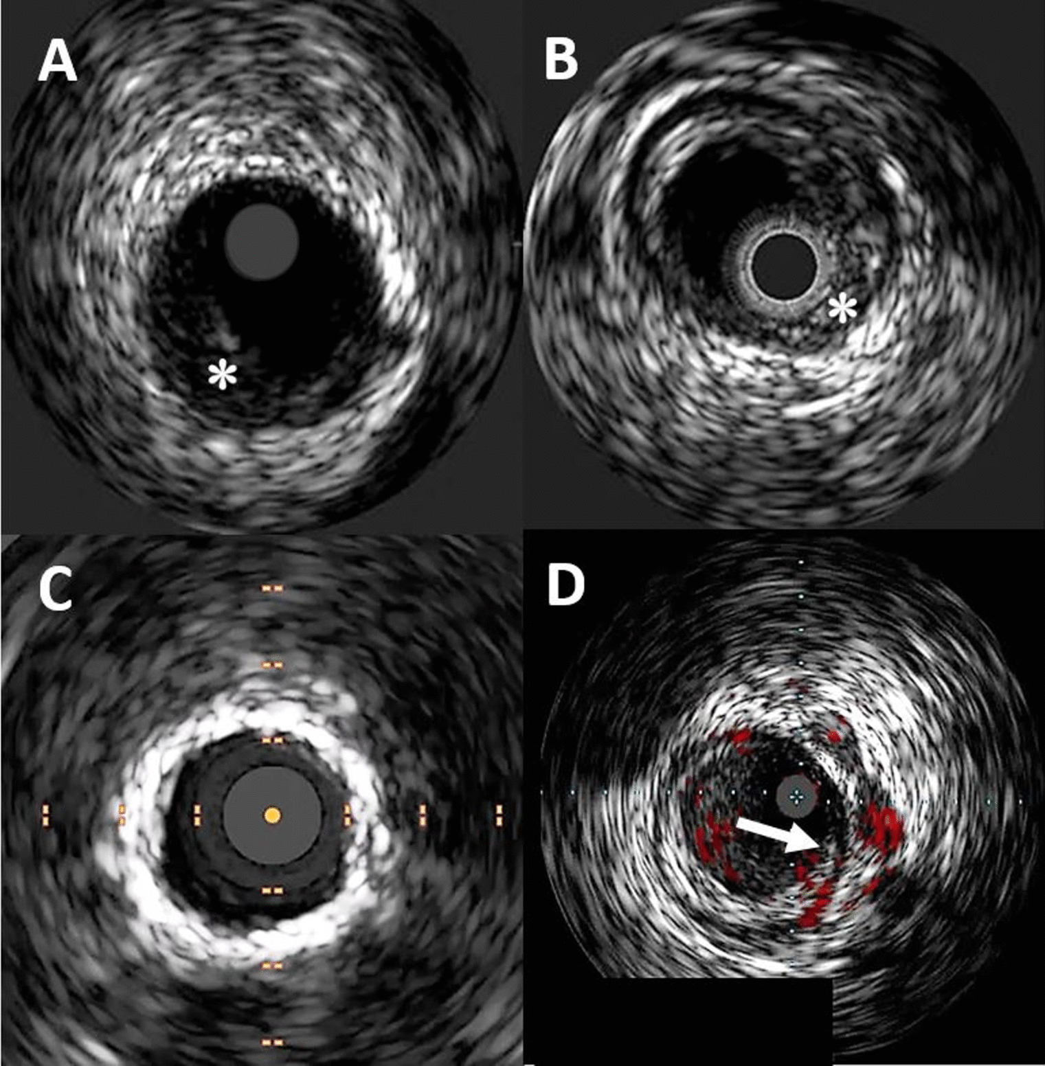Intravascular Imaging for Peripheral Artery Disease and Endovascular Intervention of the Lower Extremities