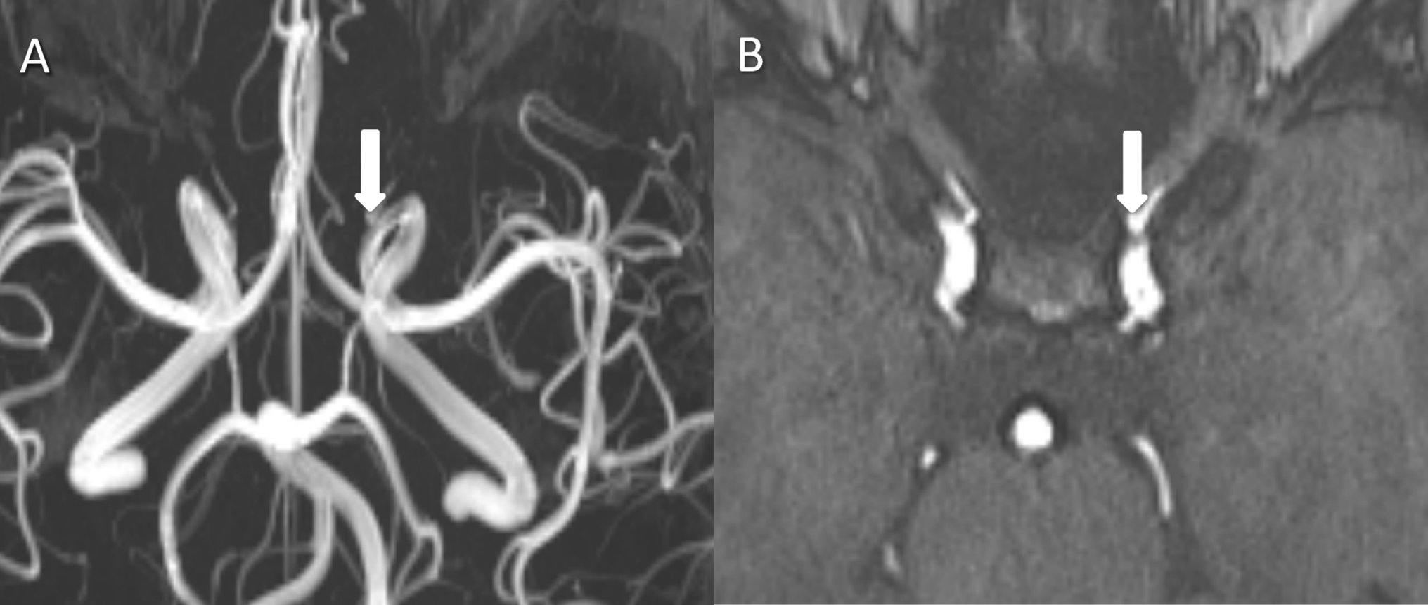 RE: acute aortic dissection in a patient with hereditary hemorrhagic telangiectasia associated with juvenile polyposis due to SMAD4 mutation
