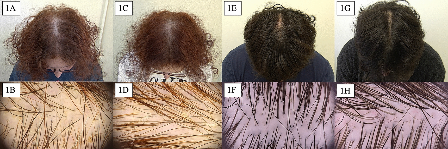 Efficacy of Skin Patting and Iontophoresis with Dutasteride Gel in Male and Menopausal Female Androgenetic Alopecia: A Pilot Study