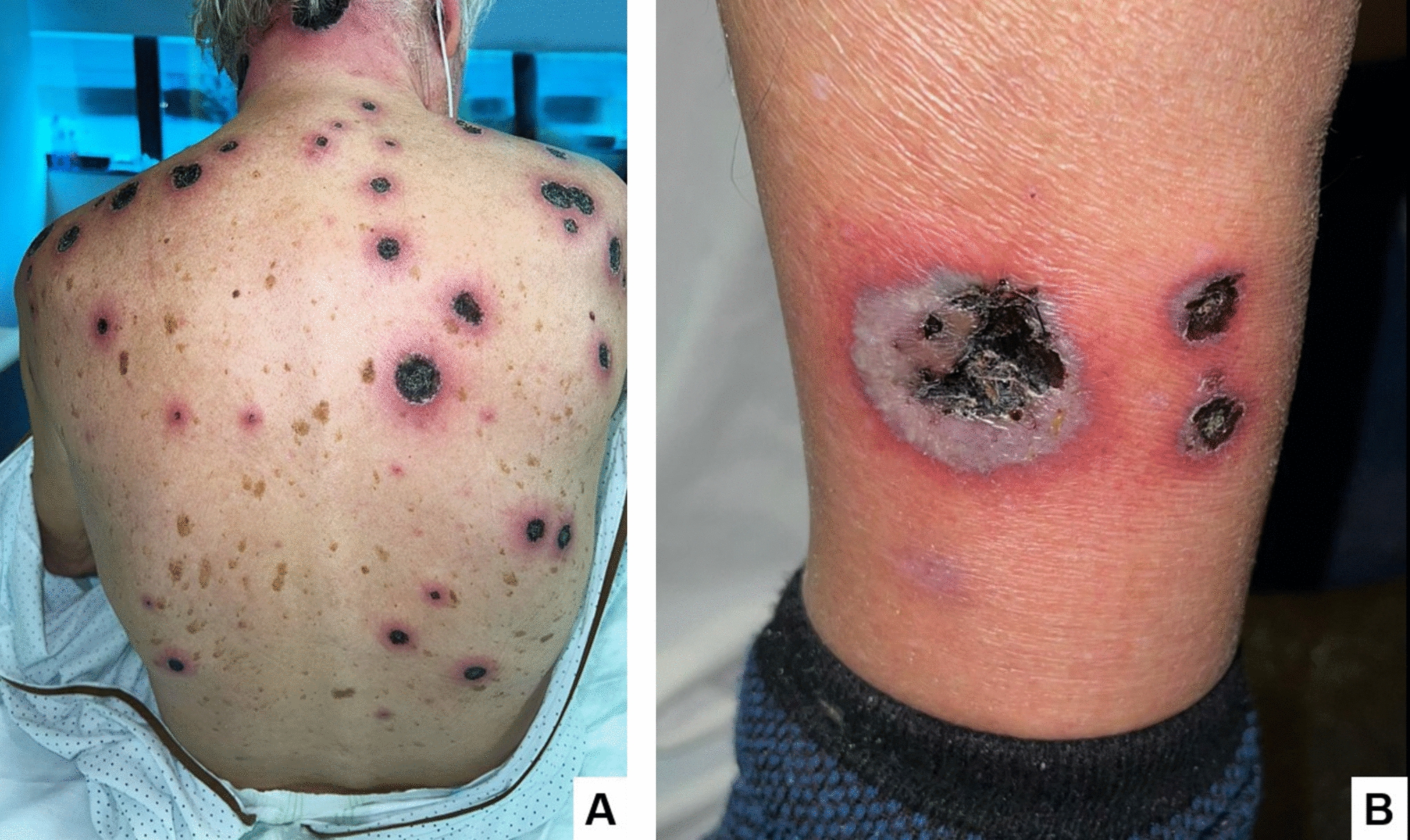 Ecthyma gangrenosum of atypical origin