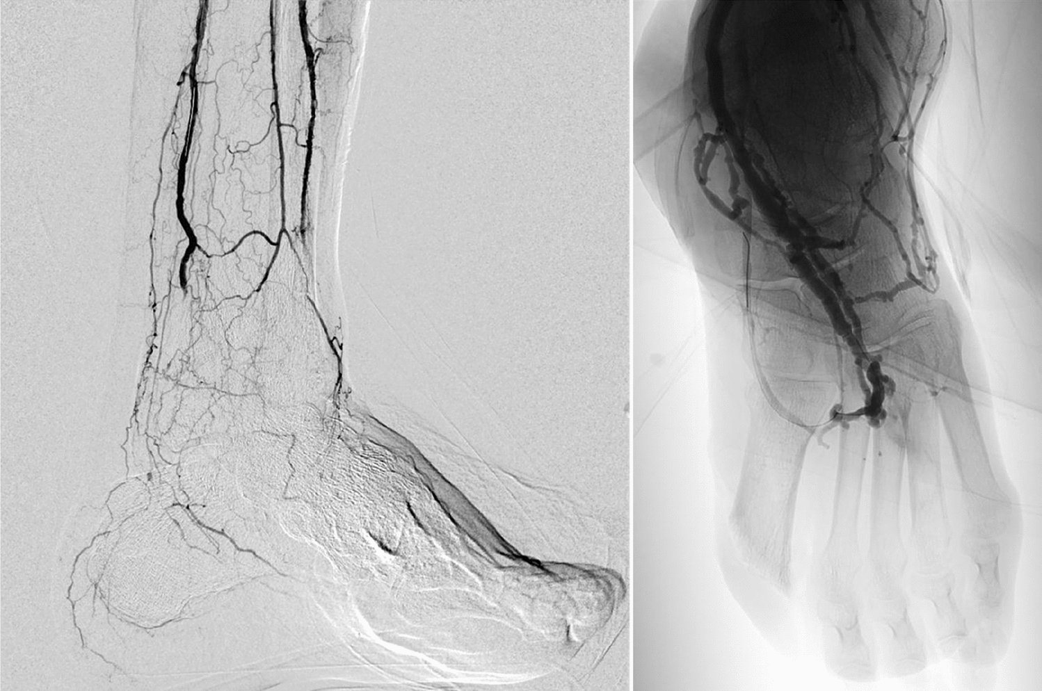 A case of diabetic foot with severe vascular disease in an elderly no-option patient undergoing lower limb arterialization: a clinical case report