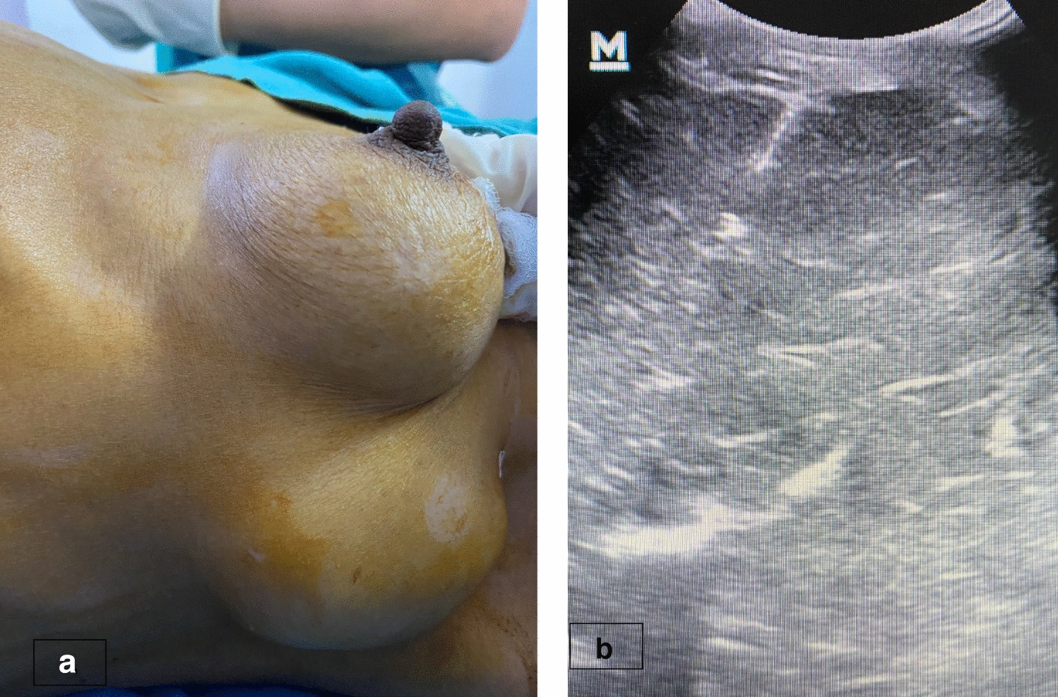 Primary Ovarian Leiomyosarcoma-Lessons Learnt from a Misdiagnosis of a Rare Case and Review of Literature