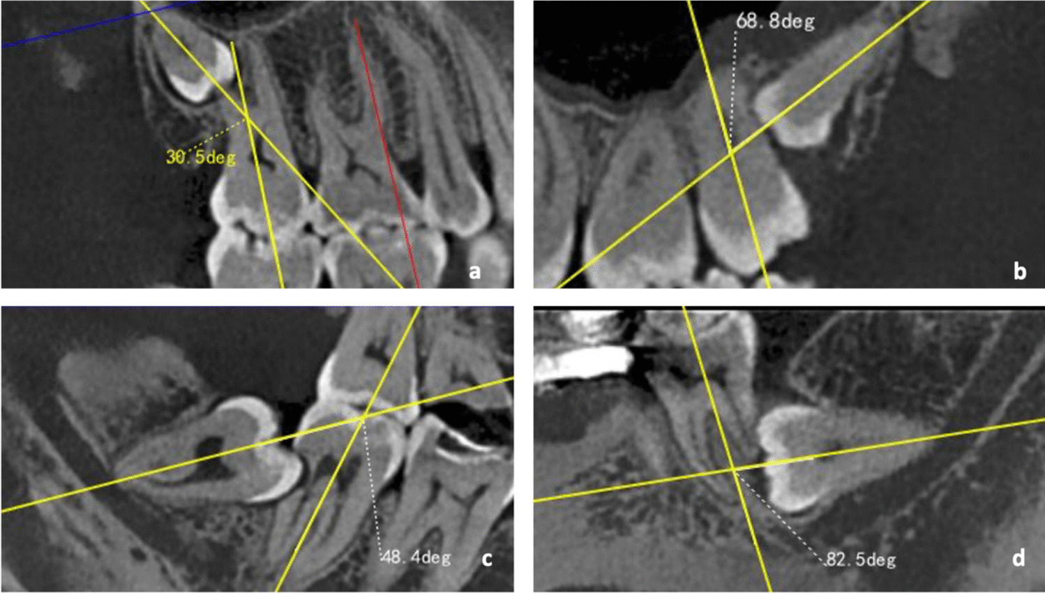 External root resorption of second molars caused by impacted third molars: CBCT characteristics