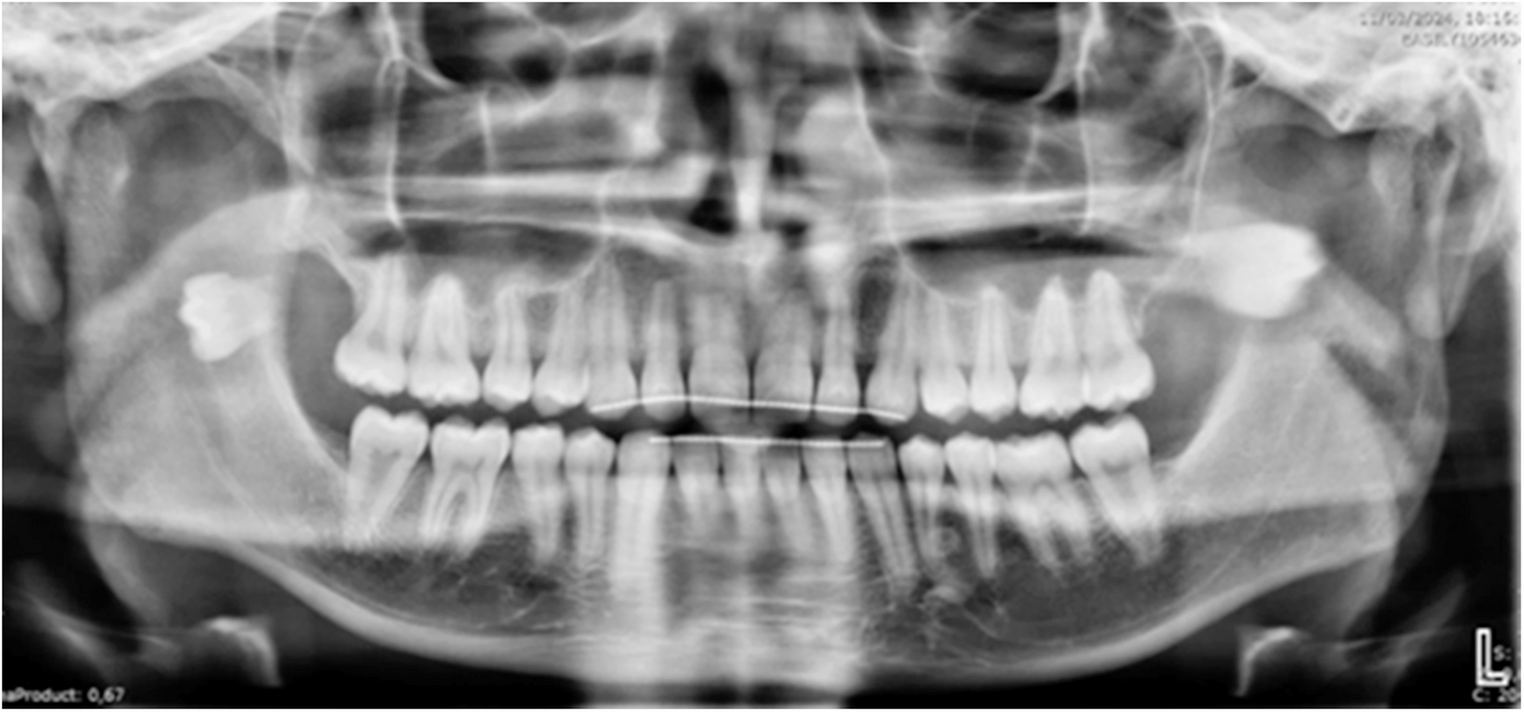 MR imaging evaluation of accidental third molar displacement into parapharyngeal space: a case report
