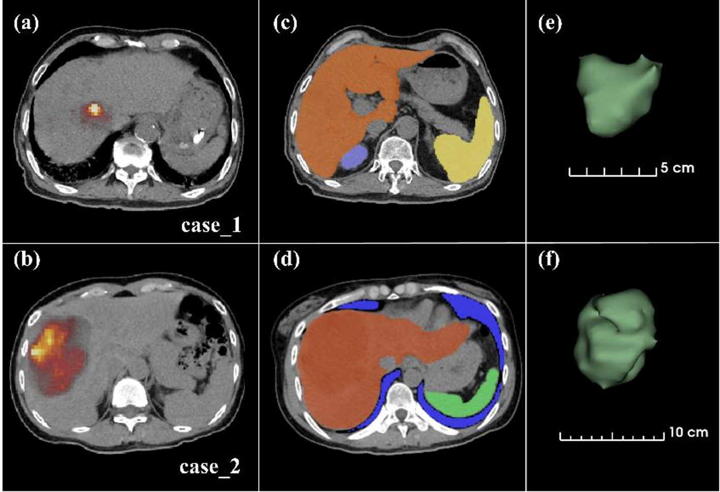 Optimizing dosimetry in Y-90 microsphere radioembolization: GPU-accelerated Monte Carlo simulation versus conventional methods for high-volume setting