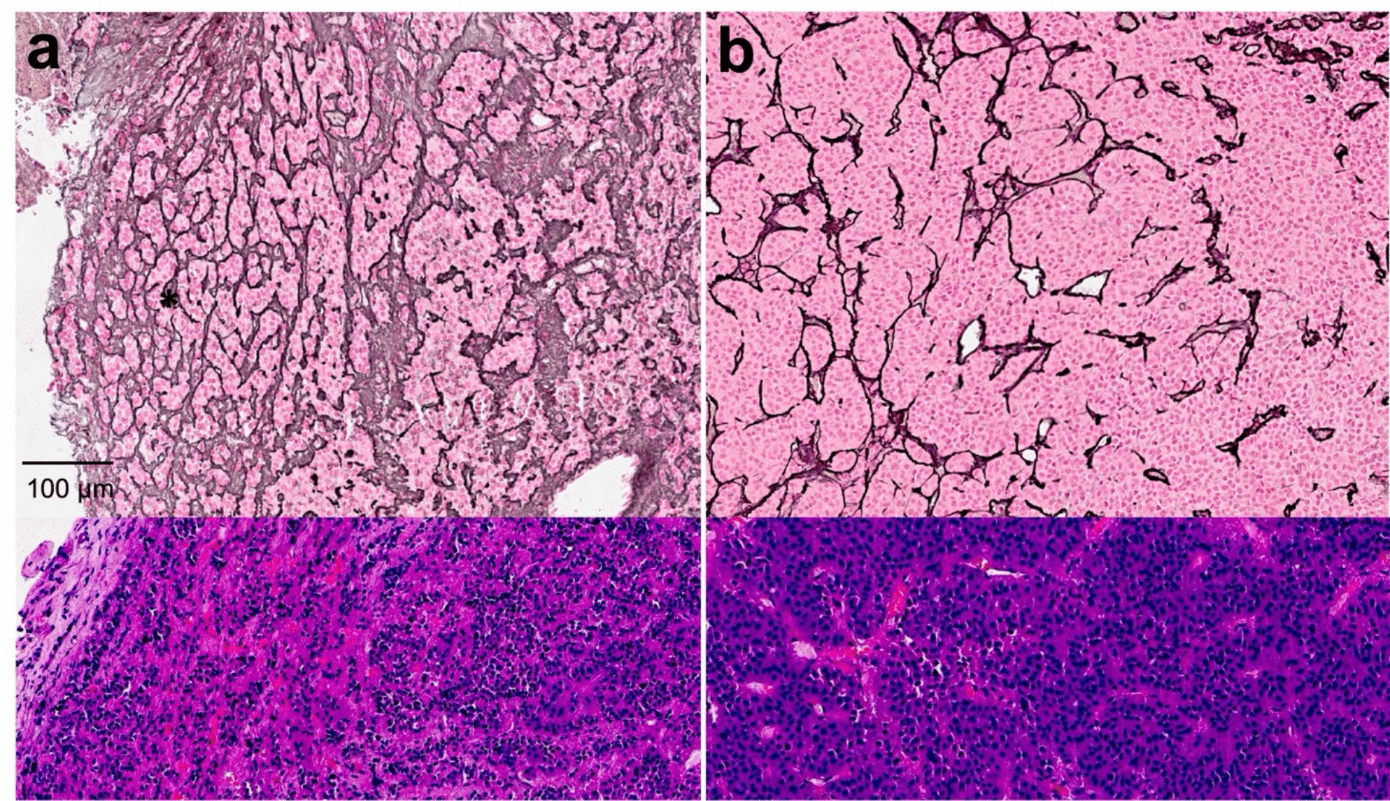 Reticulin Framework Assessment in Neoplastic Endocrine Pathology